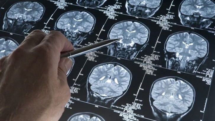 Descubren cómo células meníngeas protegen la salud cerebral