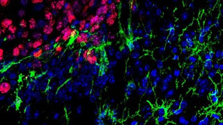 Nueva estrategia para frenar metástasis cerebrales del melanoma