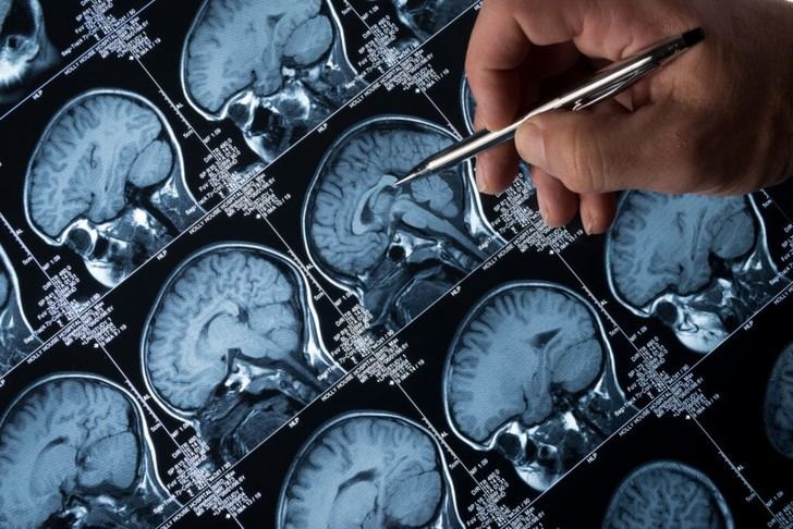 Investigadores del CSIC identifican el origen de las corrientes eléctricas en el cerebro de pacientes con epilepsia