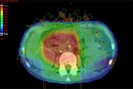 Investigación en Sevilla predice recaídas en cáncer infantil