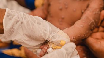 Más de 100.000 casos en todo el mundo: La OMS aprueba la primera vacuna contra el mpox