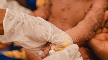 Más de 100.000 casos en todo el mundo: La OMS aprueba la primera vacuna contra el mpox